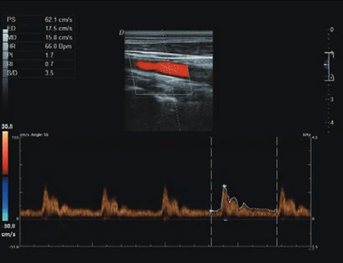 H30 Portable Color Doppler Ultrasound 4